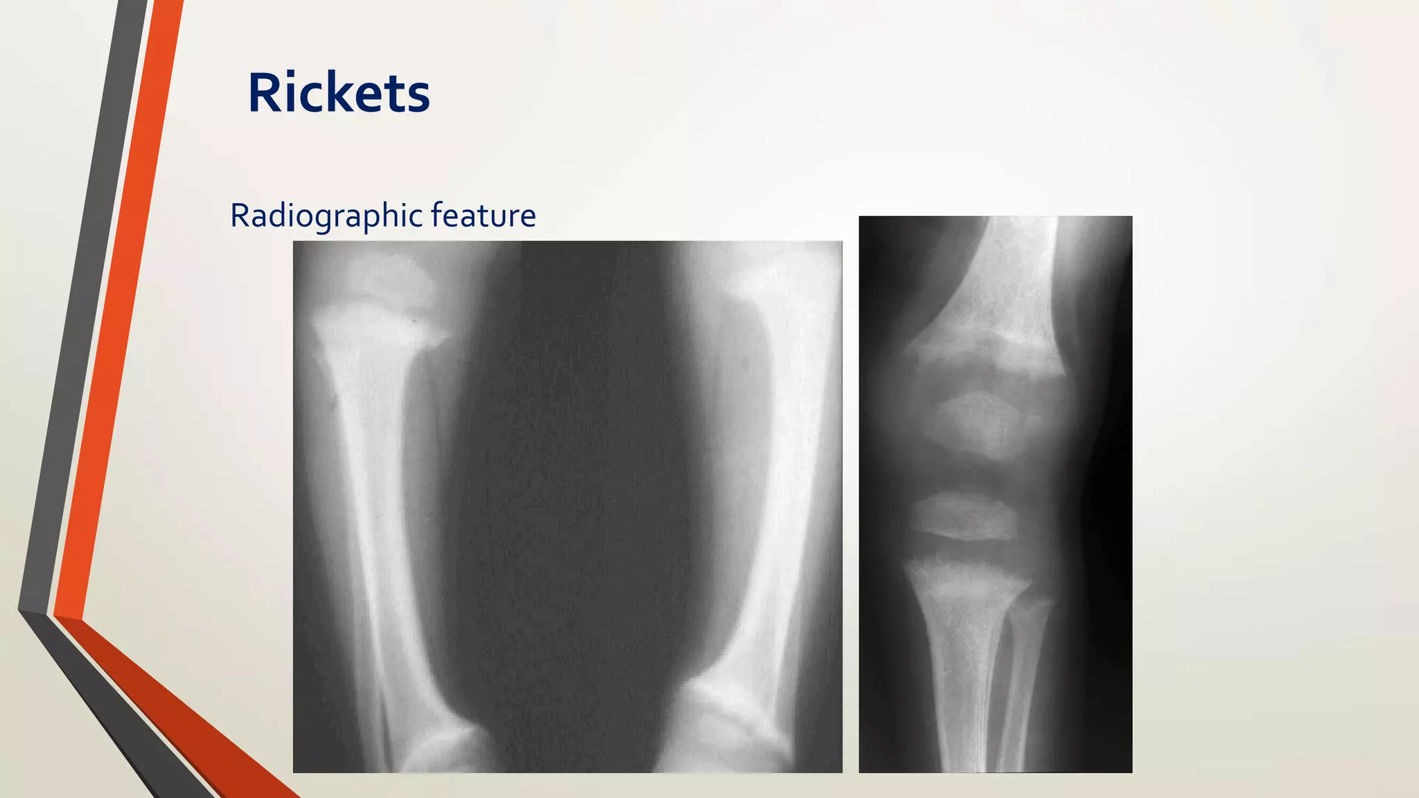 Ricket and osteomalacia | PPTX