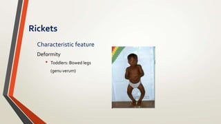 Black Rickets Ricket and osteomalacia | PPTX