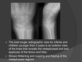 Defective 25-hydroxylase ricketsDrug-induced ricketsRenal causesFanconi syndrome