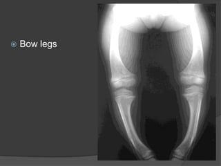 Renal osteodystrophyNutritional Ricketsthe most common cause of rickets globally Dietary rickets can be a consequence of inadequate intake of calcium, vitamin D, phosphate, or a combination of these.reserves of vitamin D in the neonate highly depend on the mother's vitamin D status. More with Breast-fed infants300,000–600,000 IU of vitamin D are administered orally or intramuscularly as 2–4 doses over 1 daydaily, high-dose vitamin D, with doses ranging from 2,000–5,000 IU/day over 4–6 wkOR