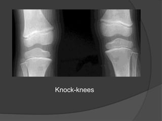 Vitamin D–dependent rickets “type I”a.k.a vitamin D pseudodeficiency (PDDR) because it can be corrected with high daily doses of vitamin DGenetic deficiency disorder, have mutations in the gene encoding renal 1α-hydroxylase Autosomal recessive inheritance, chromosome 12They have normal levels of 25-D, but low levels of 1,25-D ( LOW calcitriol), high PTH and low serum phosphorus levels.Treatment is calcitriol 0.5-1.5 mcg/d. Also respond to pharmacologic doses of vitamin D (5000-10,000 u/d). 