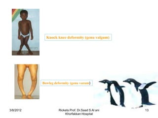 Knock knee deformity (genu valgum)




           Bowleg deformity (genu varum)




3/8/2012            Rickets Prof. Dr.Saad S Al ani   13
                        Khorfakkan Hospital
 