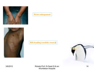 Rickets | PPTX