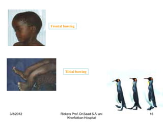 Frontal bossing




                    Tibial bowing




3/8/2012         Rickets Prof. Dr.Saad S Al ani   15
                     Khorfakkan Hospital
 