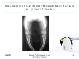 Radiograph in a 4-year-old girl with rickets depicts bowing of
                 the legs caused by loading.




3/8/2012             Rickets Prof. Dr.Saad S Al ani         22
                         Khorfakkan Hospital
 