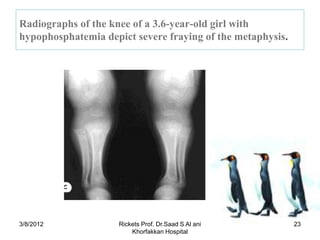 Radiographs of the knee of a 3.6-year-old girl with
hypophosphatemia depict severe fraying of the metaphysis.




3/8/2012             Rickets Prof. Dr.Saad S Al ani         23
                         Khorfakkan Hospital
 