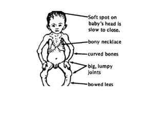 Rickets Figure Rickets | PPT