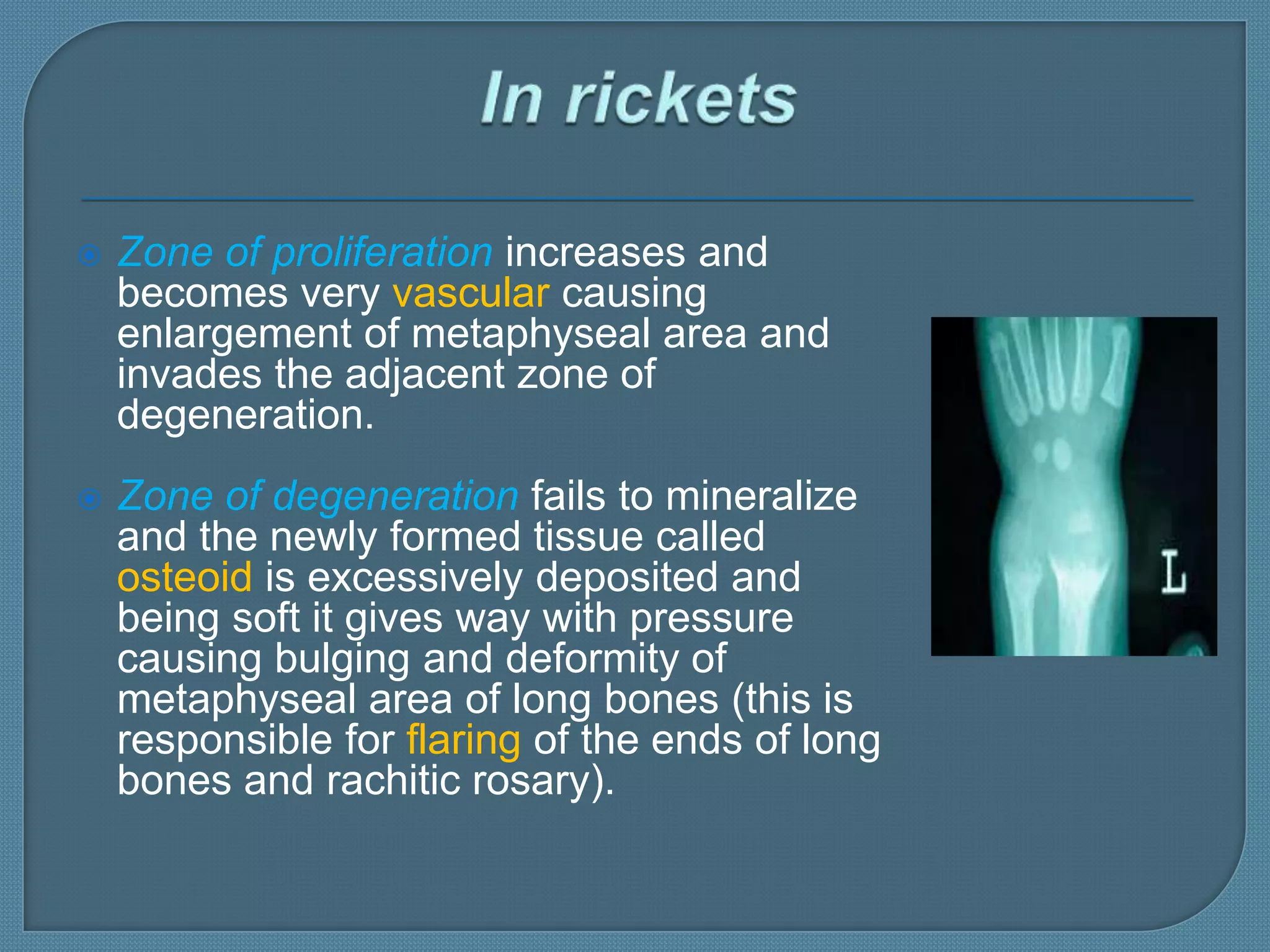 Rickets lecture | PPTX