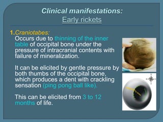 1.Craniotabes:
Occurs due to thinning of the inner
table of occipital bone under the
pressure of intracranial contents with
failure of mineralization.
It can be elicited by gentle pressure by
both thumbs of the occipital bone,
which produces a dent with crackling
sensation (ping pong ball like).
This can be elicited from 3 to 12
months of life.
 