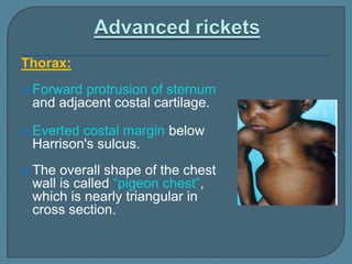 Thorax:
 Forward protrusion of sternum
and adjacent costal cartilage.
 Everted costal margin below
Harrison's sulcus.
 The overall shape of the chest
wall is called “pigeon chest”,
which is nearly triangular in
cross section.
 