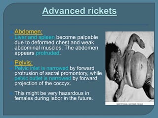  Abdomen:
 Liver and spleen become palpable
due to deformed chest and weak
abdominal muscles. The abdomen
appears protruded.
 Pelvis:
 Pelvic inlet is narrowed by forward
protrusion of sacral promontory, while
pelvic outlet is narrowed by forward
projection of the coccyx.
 This might be very hazardous in
females during labor in the future.
 