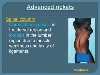 Spinal column:
Correctable kyphosis in
the dorsal region and
lordosis in the lumbar
region due to muscle
weakness and laxity of
ligaments.
Scoliosis
 