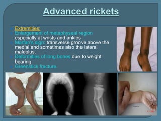  Extremities:
 Enlargement of metaphyseal region
especially at wrists and ankles
 Marfan's sign: transverse groove above the
medial and sometimes also the lateral
maleolus.
 Deformities of long bones due to weight
bearing.
 Greenstick fracture.
 