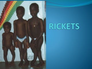 Rickets Support Kit Rickets | PPTX