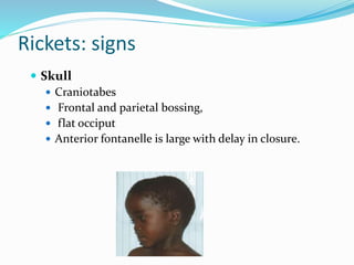 Rickets | PPTX