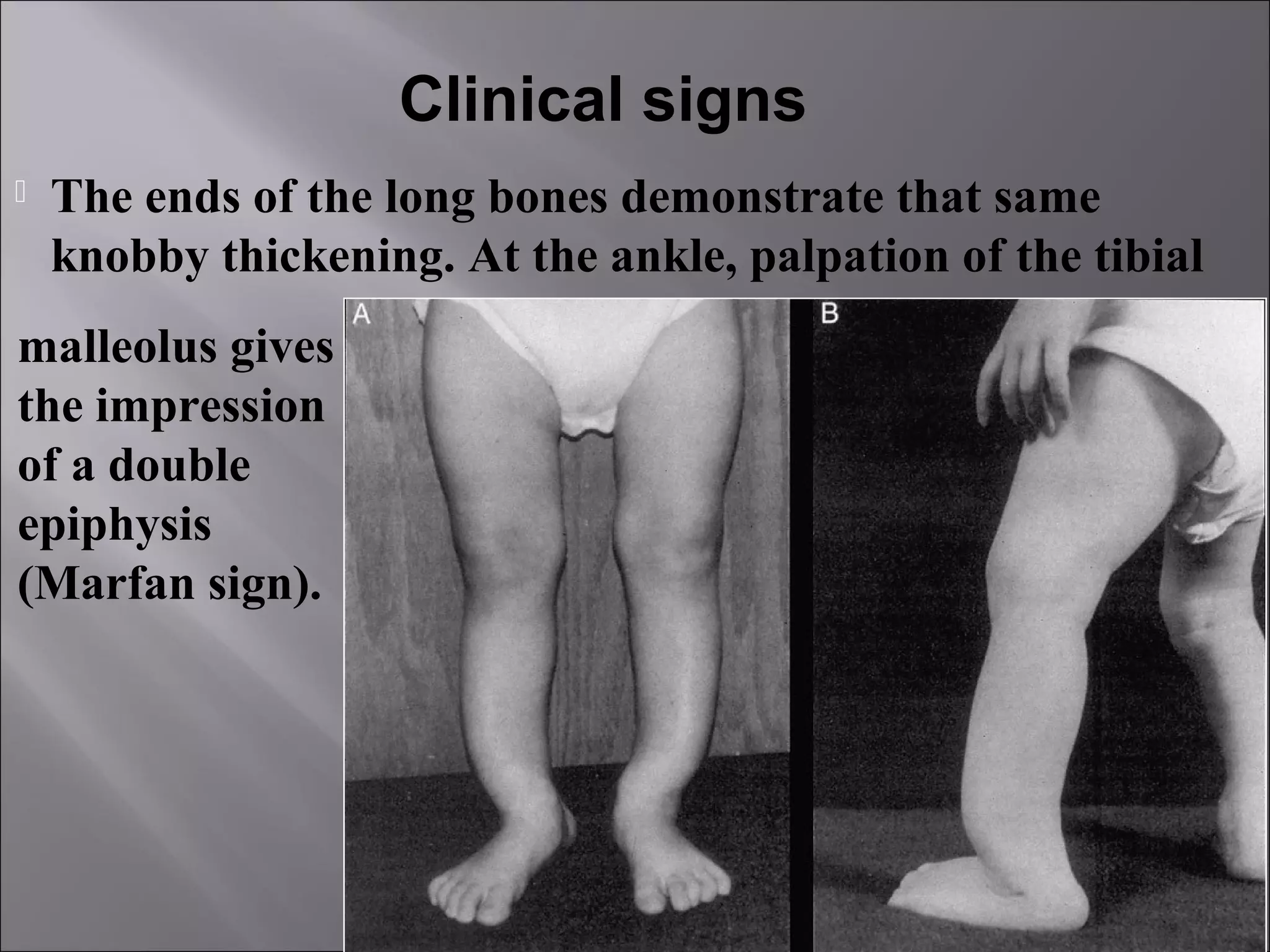 Rickets | PPT