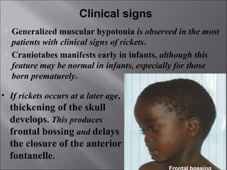 Head In Rickets Rickets | PPT