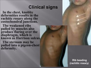 Rickets | PPT