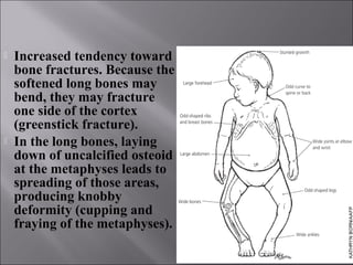 Rickets | PPT