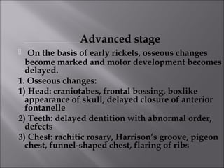 Rickets | PPT