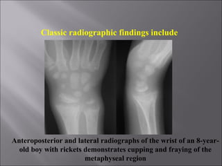 Rickets in wrist - uncalcified lower ends of bones
are porous, ragged, and saucer-shaped
(A) Rickets in 3 month old infant...