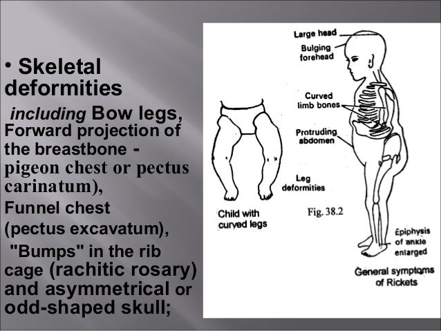 Rickets