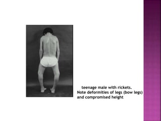 Rickets a brief outlook | PPTX
