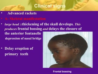Rickets | PPT