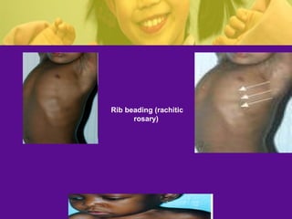 Rickets | PPT