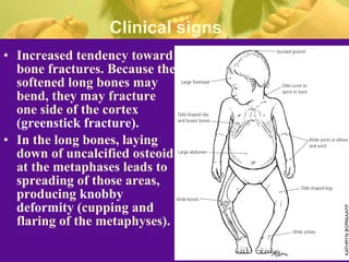 Rickets | PPT