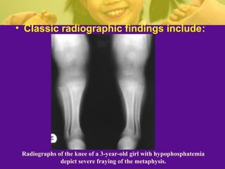 Rickets | PPT