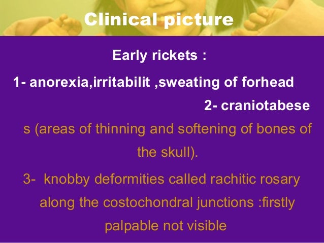 Rickets