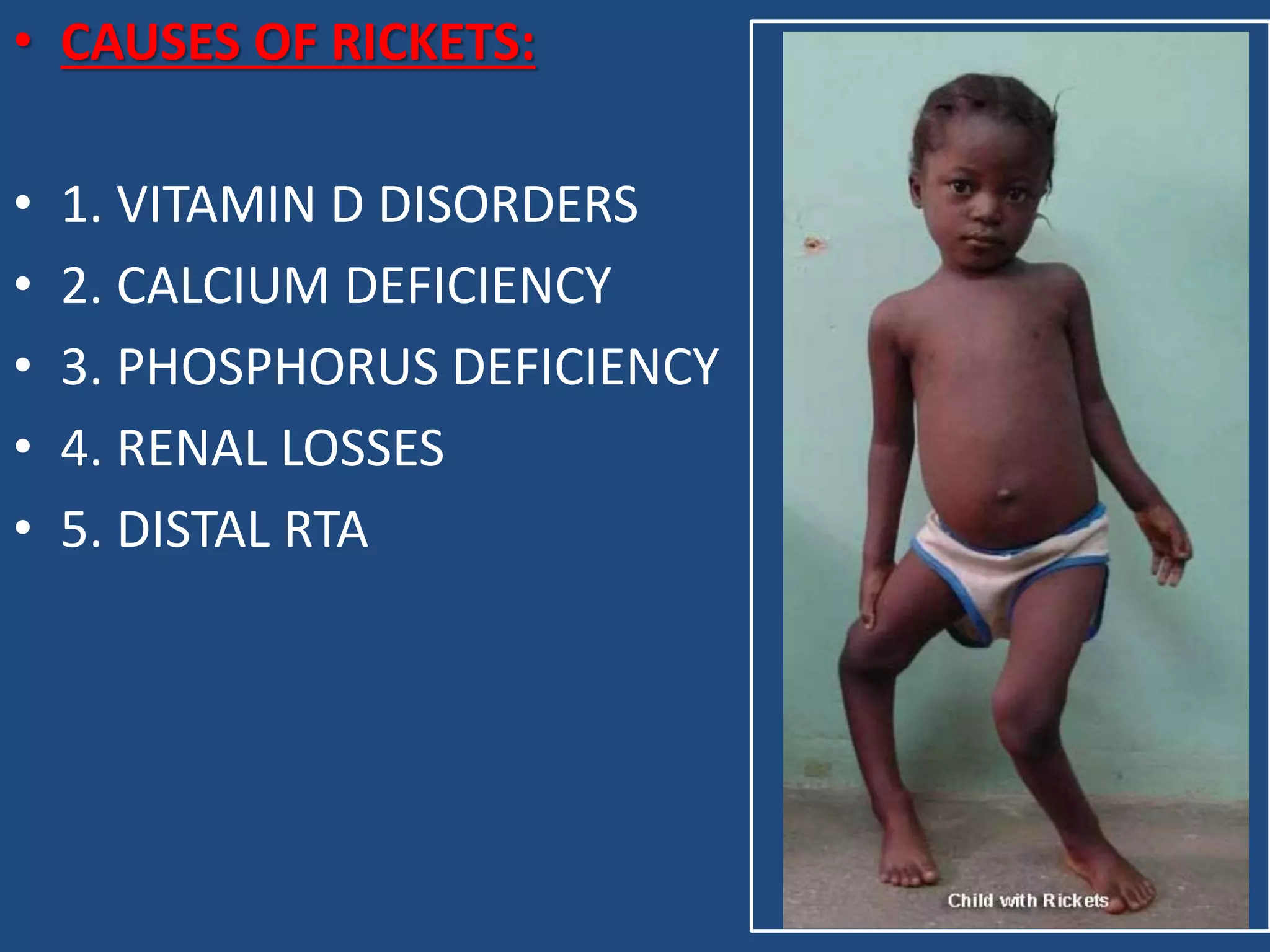 Rickets Dr Padmesh PPTX