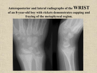 Anteroposterior and lateral radiographs of the WRIST
of an 8-year-old boy with rickets demonstrates cupping and
fraying of the metaphyseal region.
 