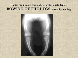 Radiograph in a 4-year-old girl with rickets depicts
BOWING OF THE LEGS caused by loading.
 