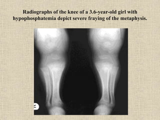 Radiographs of the knee of a 3.6-year-old girl with
hypophosphatemia depict severe fraying of the metaphysis.
 
