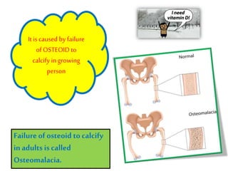 Rickets is defective
mineralization or
calcification of bones
before epiphyseal
closure in immature
mammals due to deficiency
or impaired metabolism
of vitamin D,
phosphorus or calcium
potentially leading to
fractures and deformity.
Failureof osteoid to calcify
in adults is called
Osteomalacia.
It is caused by failure
of OSTEOID to
calcify ingrowing
person
 