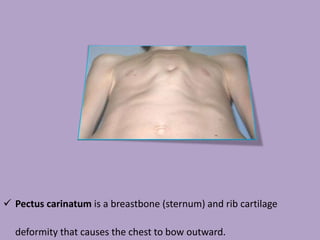  Enamel hypoplasia is a defect of the teeth in which the enamel is
hard but thin and deficient in amount. Harrison's groove, also known as Harrison's sulcus, is a
horizontalgroove along the lower border of the thorax corresponding
to the costal insertion of the diaphragm.
 Craniotabes is the finding of a softening or thinning of the skull.
 Pectus carinatum is a breastbone (sternum) and rib cartilage
deformity that causes the chest to bow outward.
 