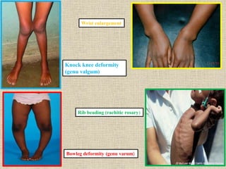 Knock knee deformity
(genu valgum)
Bowleg deformity (genu varum)
Wrist enlargement
Rib beading (rachitic rosary)
 