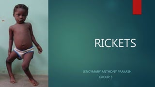 RICKETS
JENCYMARY ANTHONY PRAKASH
GROUP 3
 