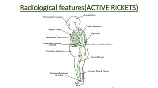 Rickets | PPTX