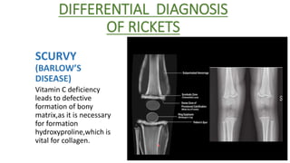 Table Rickets Differential Rickets | PPTX