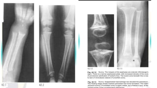 Rickets | PPTX