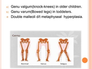 a) Genu valgum(knock-knees) in older children.
b) Genu varum(Bowed legs) in toddelers.
 Double malleoli d/t metaphyseal hyperplasia.
 
