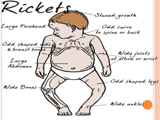 Rickets | PPTX