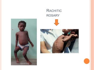 Rickets | PPTX