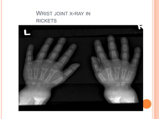 Rickets | PPTX