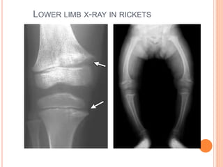 Head In Rickets Rickets | PPTX
