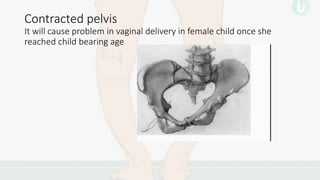 Rickets | PPTX