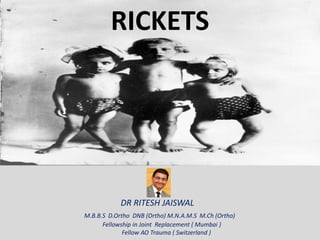 DR RITESH JAISWAL
M.B.B.S D.Ortho DNB (Ortho) M.N.A.M.S M.Ch (Ortho)
Fellowship in Joint Replacement ( Mumbai )
Fellow AO Trauma ( Switzerland )
RICKETS
 